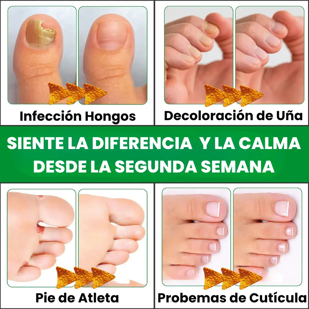 🔝Bye Bye Hongos → Renueva Uñas Premium